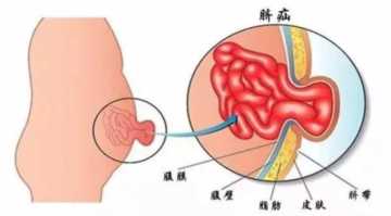 不可思议！男婴肚脐外鼓，爸爸为放气竟拿起刀片划一下