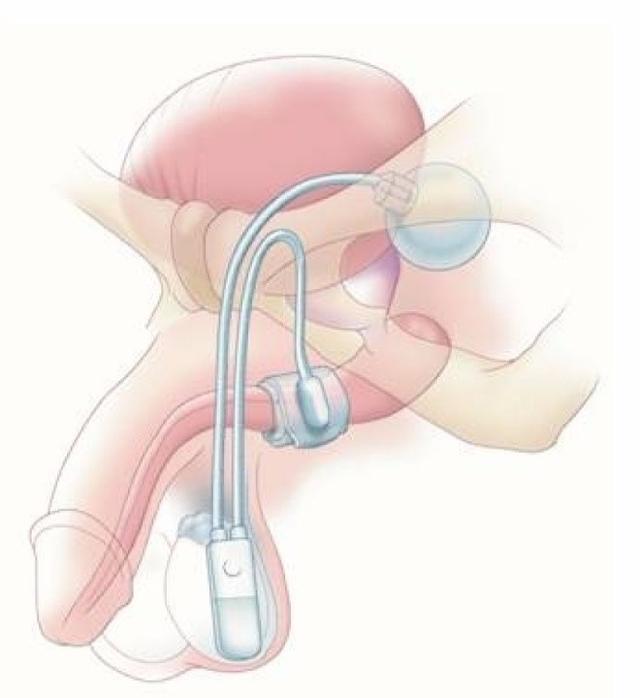 同济大学附属同济医院完成首例人工阴茎假体联合人工尿道括约肌植入术
